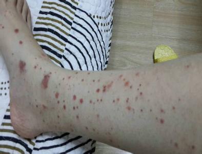 反复出现皮肤瘀斑的疾病 过敏性紫癜严重吗