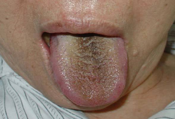 舌苔厚黄是怎么回事