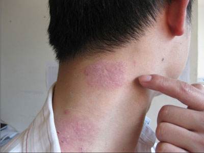 红斑狼疮早期症状 什么原因引起红斑狼疮