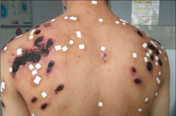 顽固皮肤疾病疤痕疙瘩治疗方法你知道吗