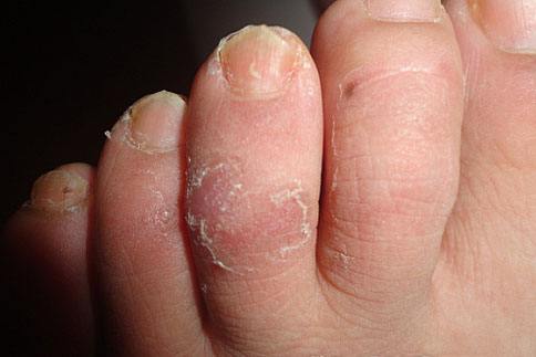 冬天受的伤 冻疮怎么根治