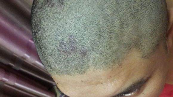 头皮脂溢性皮炎