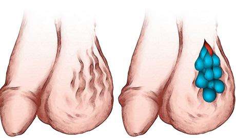 治疗精索静脉曲张