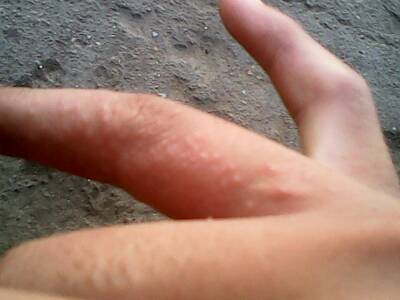 汗疱疹的中西医结合治疗法