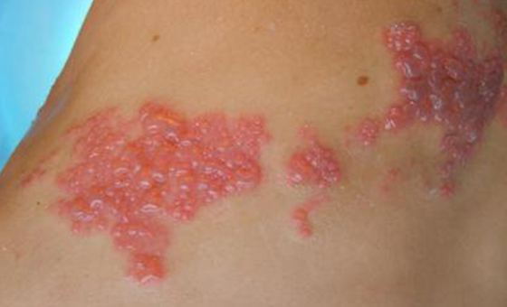 疱疹如何治疗 疱疹患者有必要了解的五个小偏方