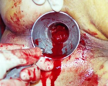 严重影响生活的疾病内痔出血的危害你知道吗