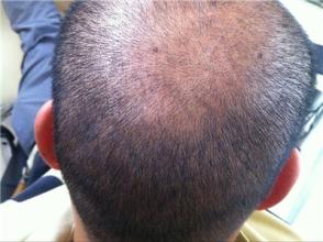 头发稀疏怎么回事及头发稀疏怎么处理的知识点