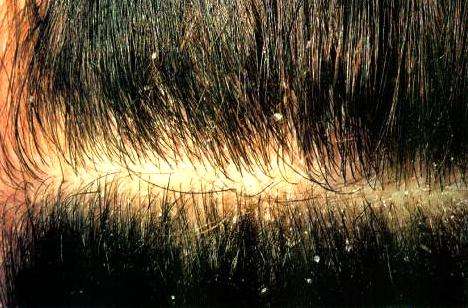 头皮脂溢性皮炎