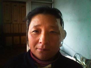 面神经炎 面瘫的早期症状有哪些你知道吗