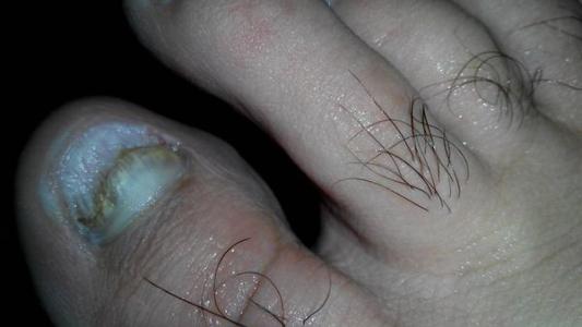 脚趾甲变厚怎么治疗 脚趾甲变厚也是病得治