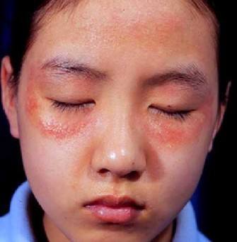 脸部过敏
