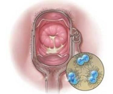 痔疮引起肛门湿疹怎么办 肛门湿疹怎么治疗