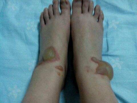 开水烫伤如何处理 三种烫伤程度的有效方法