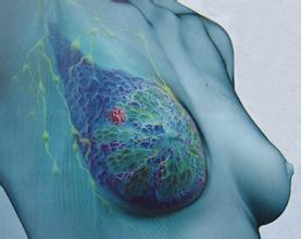 女性乳房的杀手 乳腺癌是怎么引起的