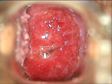 折磨女性的炎症宫颈糜烂是怎么引起的
