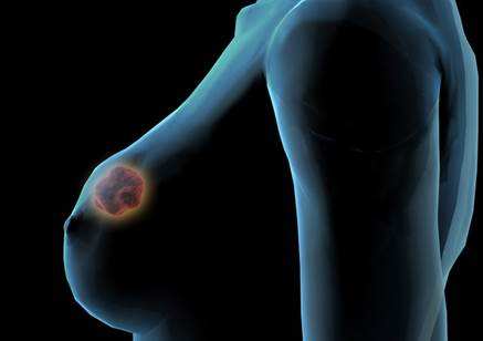 乳腺增生怎么办 别慌乳腺增生有食疗偏方