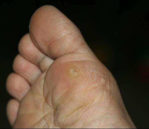 跖疣是怎么引起的 跖疣最佳治疗方法