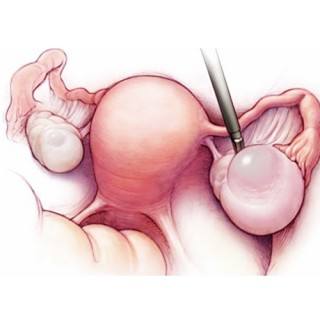 常见妇科疾病妇科卵巢囊肿的原因大家知道吗