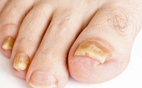 灰指甲偏方 灰指甲变亮甲的有效偏方