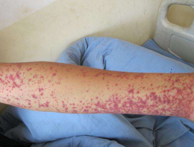 过敏性紫癜怎么治疗