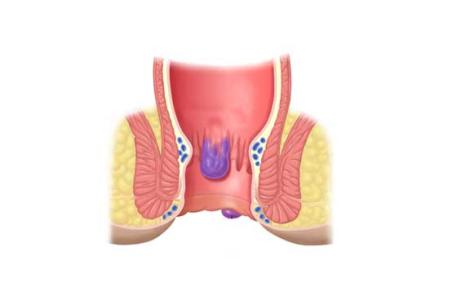 内痔疮的最佳治疗方法 三种治疗内痔疮的手术你了解了吗