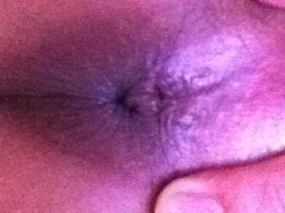 外痔疮的最佳治疗方法