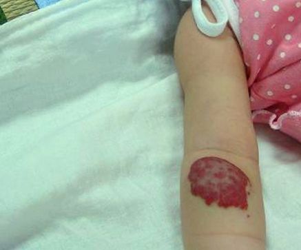 肝脏血管瘤严重吗