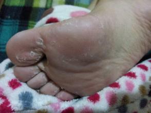 如何去死皮 这些方法简单又高效