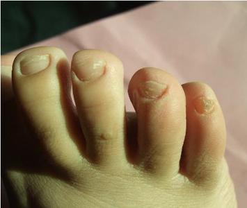 灰指甲对人体的极大危害 治疗灰指甲民间偏方