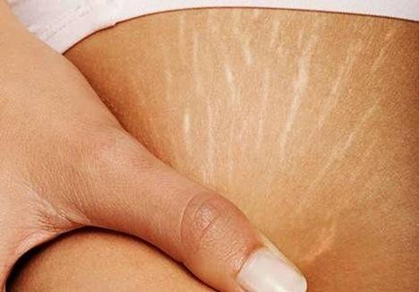 产后如何消除妊娠纹 几个小偏方还你光滑的肚皮