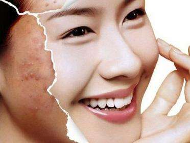 民间去痘秘籍之去痘小偏方