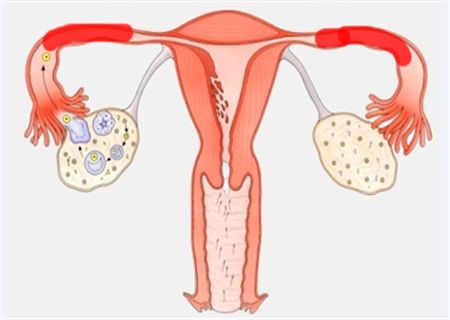 导致女性不孕的罪魁祸首 输卵管堵塞怎么治疗