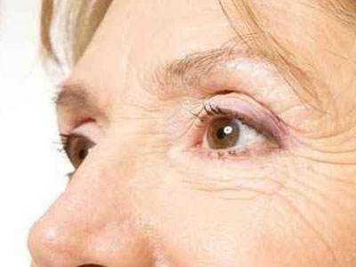 去除老年斑小偏方