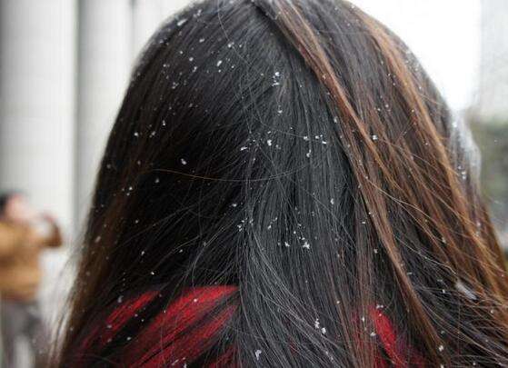 怎么去头屑 去头屑有妙招