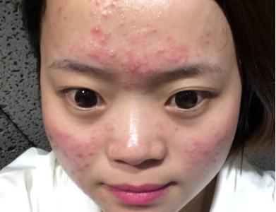 毁三观的脸部痤疮如何治疗
