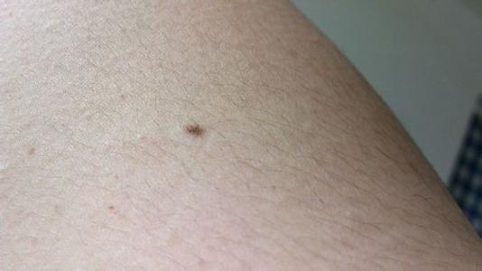 血癌的早期症状