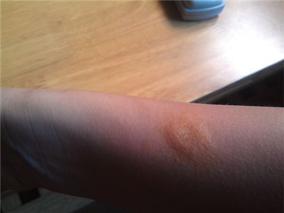 祛除疤痕的几种方法让肌肤美白如初