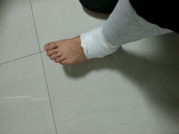 脚踝骨折的病因及影响骨折恢复几个因素