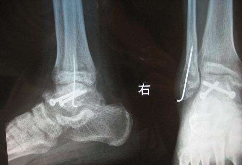 脚踝骨折的病因及影响骨折恢复几个因素