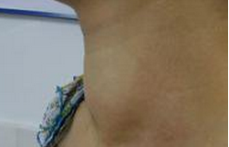 甲亢的早期症状 气喘 心律不齐 心绞痛