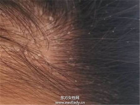 压力大15岁少女变成 白屑魔女