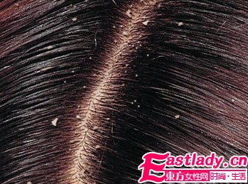 秋冬季节如何避免头皮屑