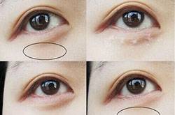 眼部脂肪粒怎么去除 六大方法帮你赶跑脂肪粒