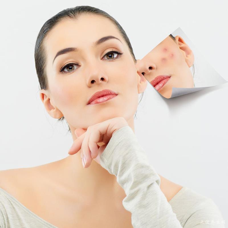 教你祛痘小秘方