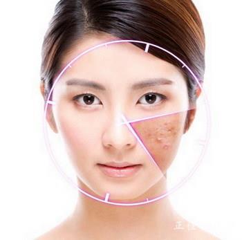 教你祛痘小秘方