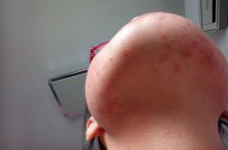 引起下巴痤疮的六大原因 千万不能用手挤