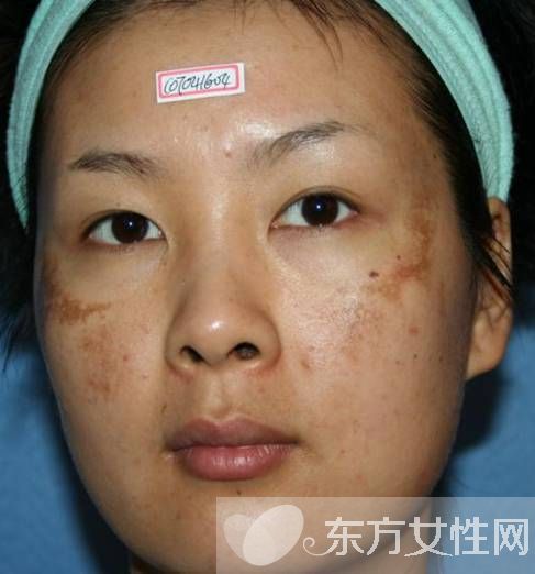 如何有效去除色斑黄褐斑
