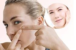 长痘痘不能吃什么 这4种食物千万别碰