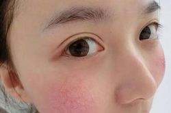 探究红血丝形成原因 四小妙招去除红血丝
