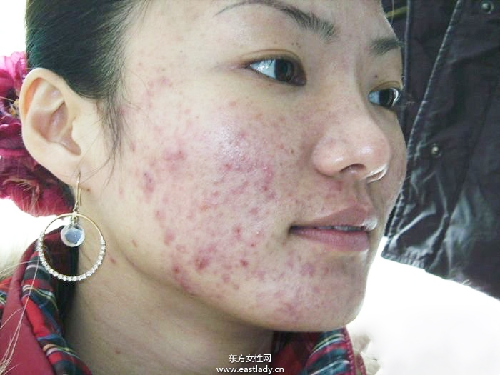 痘坑修复水能快速的解决痘印问题 是真的吗